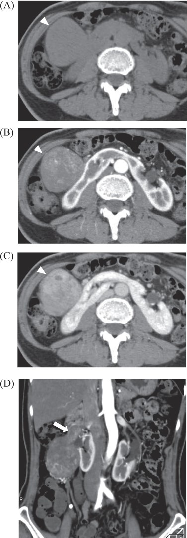 Abdominal enhanced computed tomography: there was a tumor, 80 × 40 mm in diameter at the ventral side of the right kidney and dorsal side of the duodenum, which was enhanced in late phase (A: plane; B: arterial phase; C: late phase, arrowhead). Tumor located in the right ovarian vein and tumor thrombosis was detected (D, arrow).