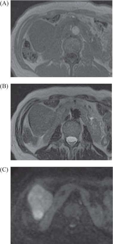 Abdominal MRI: tumor revealed iso intensity with muscle in T1 weighted image (A), slightly high intensity in T2 weighted image (B) and abnormal signal in diffuse weighted image (C).