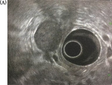 Endoscopic ultrasonography: there was no finding of infiltration to the right kidney and the duodenum.