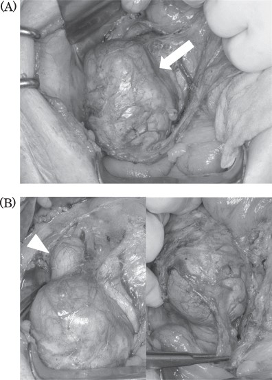 Intraoperative findings: tumor located in the retroperitoneum (A, arrow). Tumor did not invade to any other organs. Right ovarian vein throughout the tumor and tumor thrombosis was detected (B, arrowhead).