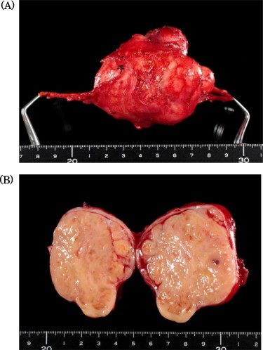 Specimen showed a solid tumor with white color, 80 × 40 mm in diameter.