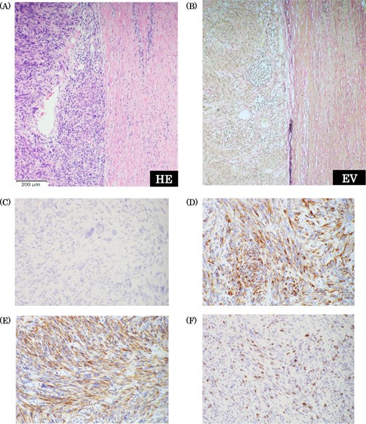 Pathological findings. (a) Hematoxylin-Eosin staining (×10): there were findings of high glade abnormal mitosis and proliferation of the spindle cells in fusiform. (b) Elastica van Gieson staining: there were component of elastic fiber in the tumor. (c) c-kit staining: negative. (d) Desmin staining: positive. e) Smooth muscle actin staining: positive. (f) Ki-67 index: 20%.