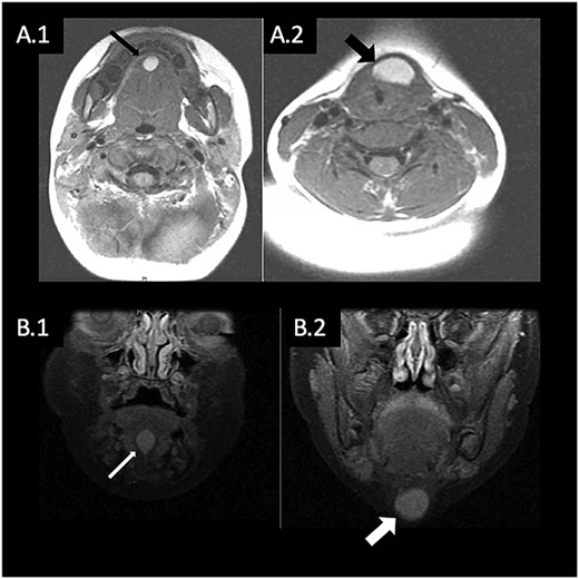 (A) T1 weighted MRI in axial plane showing hyperintense mass in the FOM (A.1) and anterior neck (A.2); (B) T1 weighted MRI in coronal plane showing hyperintense mass in the FOM (B.1) and anterior neck (B.2).
