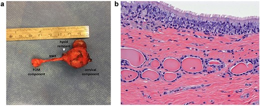 (a) Gross specimen showing multifocal cyst with thin tract. (b) Histology showing cyst lined by ciliated columnar epithelium with thyroid follicles confirming TGDC.