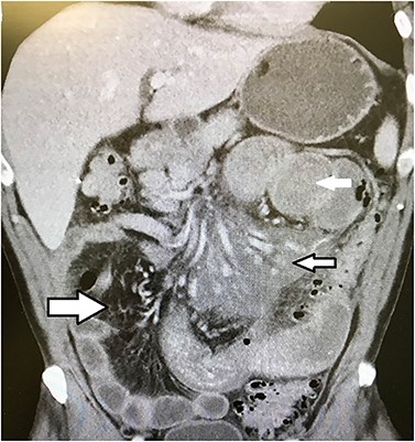 CT scan of the abdomen showing dilated proximal small bowel (solid white arrow), inflammatory changes in the proximal small bowel mesentery around the superior mesenteric artery (small black and white arrow) and normal distal mesenteric fat (large black and white arrow).