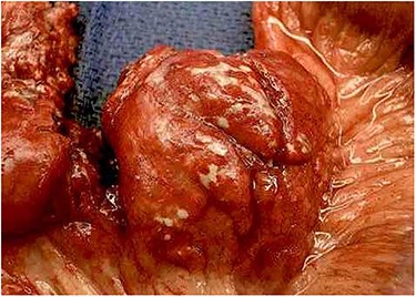 A large necrotic mesenteric lymph node with a ruptured capsule showing purulent drainage.