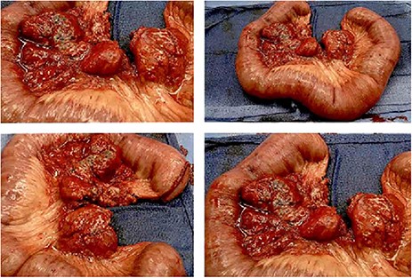 The entire excised specimen showing all of the enlarged necrotic lymph nodes and ischemic bowel.