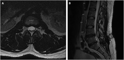 Axial (A) and Sagittal (B) T2 MRI imaging obtained preoperatively when presented for back pain, 8-months after a previous L5-S1 laminectomy/diseconomy. Images here show no evidence of pre-operative subdural fluid collection.