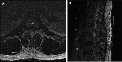 Axial (A) and sagittal (B) T2 MRI scan obtained post-operatively showing a subdural hygroma (arrow), cephalad to the site of fusion, which caused symptoms of cauda equina syndrome.