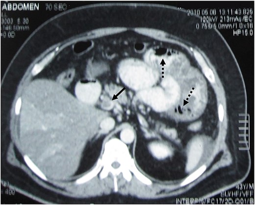 Contrast-enhanced abdominal CT demonstrating SMV thrombosis. Black arrow indicates the thrombus inside the vein, whereas the dotted black arrows indicate gas within the small-bowel wall (pneumatosis intestinalis).