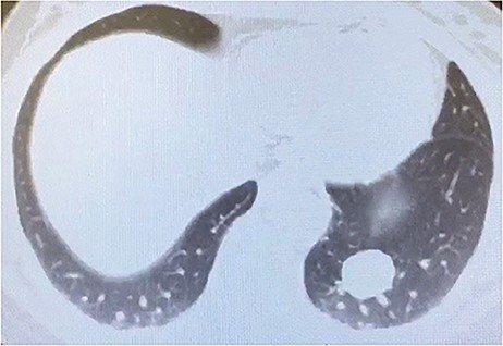 CT scan of the chest with calcified nodule in left lower lobe.