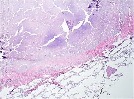 H&E of left lung nodule from wedge resection with hyalinized necrotizing granuloma and surrounding normal lung parenchyma (2×).