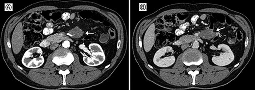 Preoperative CT; (A) arterial phase: the arrow shows the neoplastic mass traversed by the superior mesenteric artery. (B) Venous phase: the arrow shows the neoplastic mass in contact with the superior mesenteric vein.