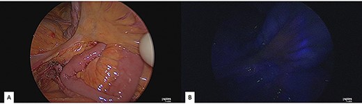 Intraoperative near-infrared angiography and indocyanine green administration; (A) normal light. (B) Application of near-infrared angiography: notice the good vascularization of the small bowel.