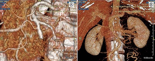 Postoperative CT with 3D vascular reconstruction; (A) arterial phase: superior mesenteric artery with its branches saved. (B) Venous phase: mesenteric-portal axis pervious.