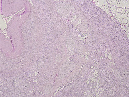 Arterial leiomyosarcoma originating from the superior mesenteric artery; notice the nuclear pleomorphism, mitotic figures and necrotic areas typical of a leiomyosarcoma.
