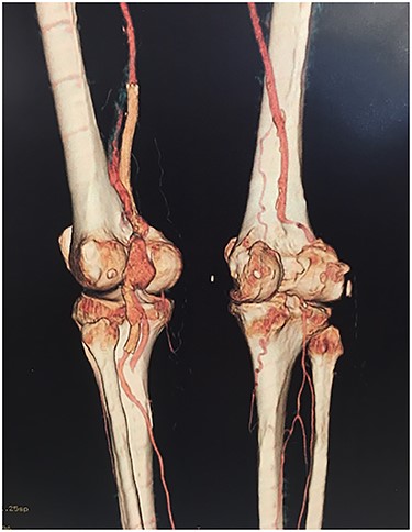 Angiotomography revealed fracture of a stent deployed in the popliteal artery and a pseudoaneurysm formation of size 4.2 cm at the part of stent fracture.