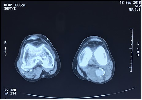 Angiotomography of the popliteal region highlighted the complete stent fracture and a large pseudoaneurysm formation.