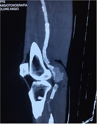 Angiotomography showing a fractured stent and pseudoaneurysm at the site of the fracture.