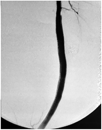 Viabahn endoprosthesis delivered after percutaneous intervention and immediately intraoperative angiogram.