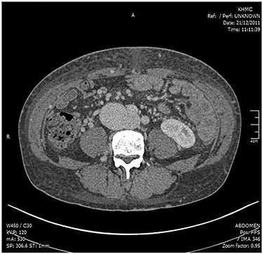 CT angiogram showing the connection between the right iliac artery and the IVC.