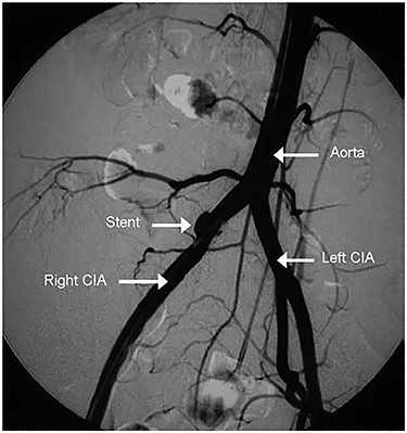 Post stent graft deployment angiogram showing the stent in position and the disappearance of AVF.