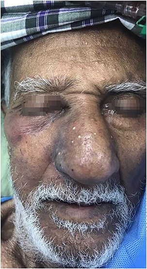 Image taken on initial presentation. Note the violaceous discoloration along the right zygomatic area with mild soft tissue swelling in that area; however, there was no obvious orbital involvement.