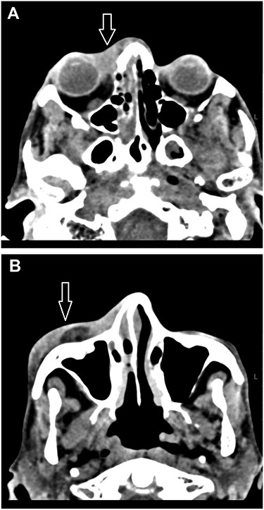 (A, B) A CT scan of the orbit and brain revealed soft tissue swelling in the pre-septal area (white arrow) and partial opacification of the right nasal cavity (A). The swelling extended to the lateral aspect of the anterior portion of the right zygomatic arch (white arrow; B).
