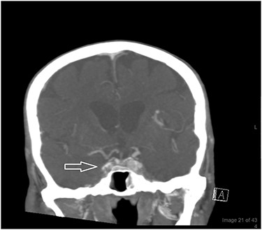 A CT brain venography revealed poor enhancement of the right cavernous sinus (white arrow) the following day. His sinuses were initially clear but later showed partial opacification of the maxillary and sphenoid sinuses with fluid levels denoting acute insult. Increased right pre-septal thickening and abnormal infiltration of the right eye were noted as well.