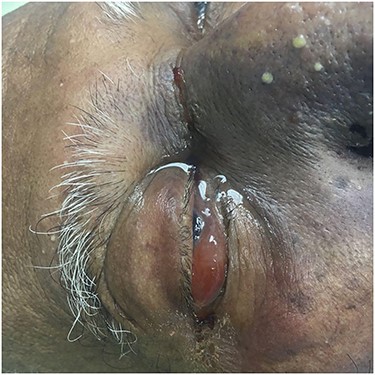Image taken on the second day of admission. Note the spontaneous laceration (not noted on admission) extending from the edge of the right medial canthus to the bridge of the nose with no signs of bleeding and the worsening of the blackish discoloration of the midface and nose bridge.