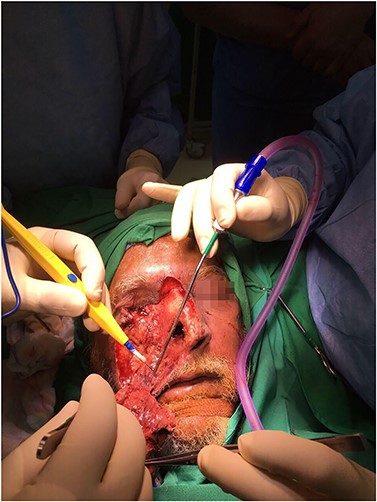 Intraoperative view of the debridement of necrotic tissue in the affected area in the right eyelids, right cheek and bridge of the nose. The paranasal sinuses were debrided endoscopically as well.