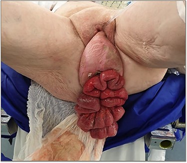 Vaginal evisceration of small bowel through prolapsed vagina on initial presentation to ED