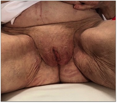 Post colpocleisis