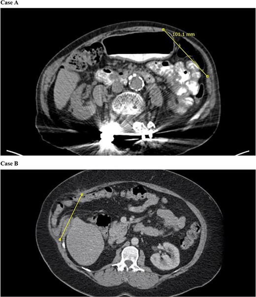 CT of the abdomen and pelvis demonstrates separation of the transversus abdominis and internal abdominal oblique from the linea semilunaris.