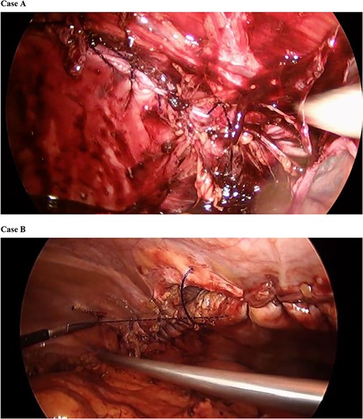 Barbed synthetic absorbable monofilament suture was used to approximate the linea semilunaris to the internal oblique.