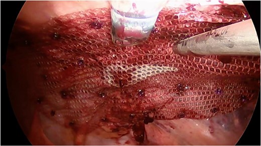Monofilament macroporous composite mesh was placed over the abdominal wall defect with 5 cm overlap to reinforce the repair. Mesh was secured with a laparoscopic absorbable tack fixation.