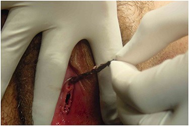 The fleshy red mass protruding from the urethra.