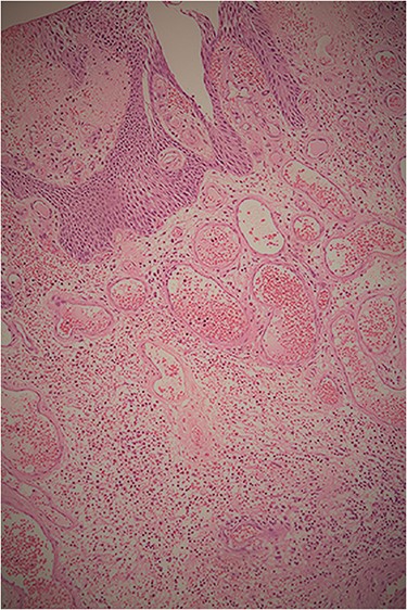 Histopathological examination showing the tumor’s polypoid structure supported by a large dense hypervascularized fibroconjunctive axis, with normal urothelium and without evidence of malignancy.