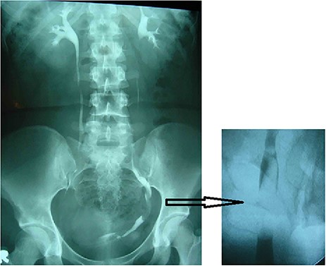 Excretory urogram (left) and RUPG (right) showing the distal left ureteral elongated regular non-obstructing filling defect.