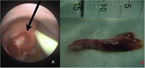 Endoscopic (A) and macroscopic (B) aspect of the resected FP of the left ureter.