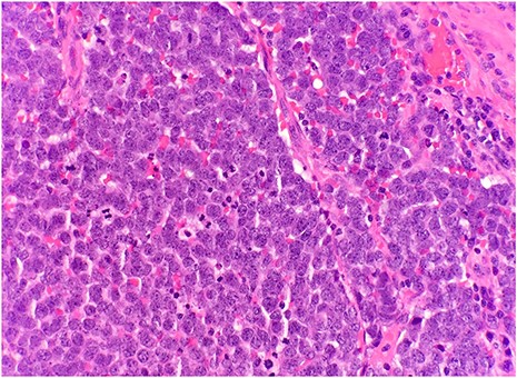 Microscopic examination reveals nests of monotonous round tumor cells. Tumor cells have scant eosinophilic cytoplasmic rim, round and vesicular nuclei with abundant mitotic figures (HE × 20).