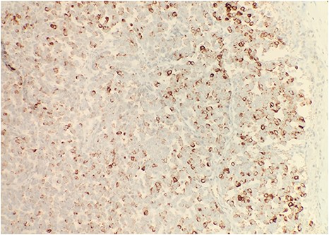 Immunohistochemical stain reveals that tumor cells are positive for synaptophysin (IHC × 20).