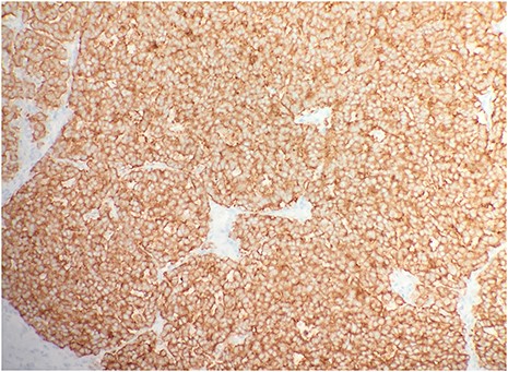 Immunohistochemical stain CK20 demonstrated paranuclear dot-like staining (IHC × 20).