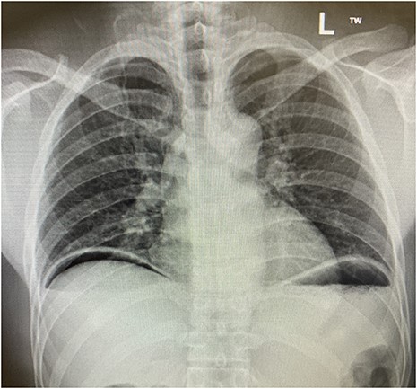 Erect chest radiograph.