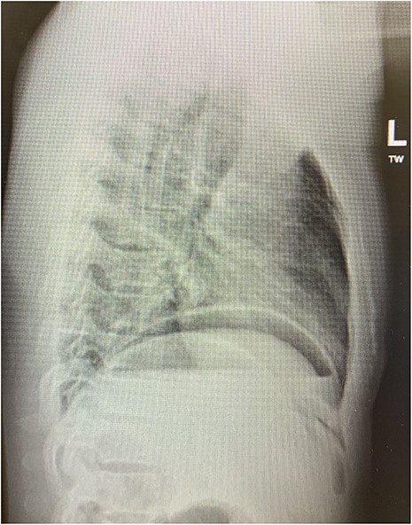 Erect chest radiograph (lateral).