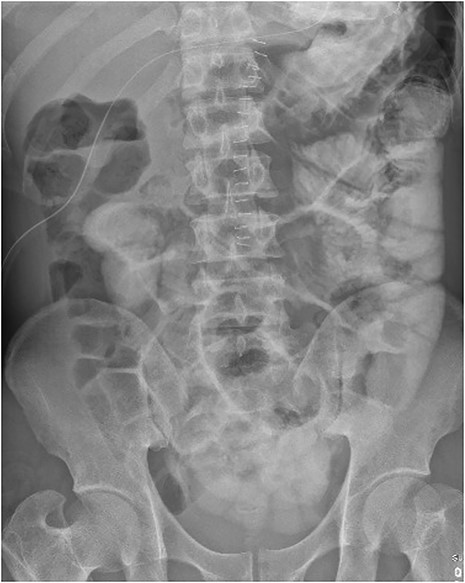 Contrast follow-through study (ileus).