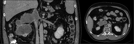 Pre-operative coronal and axial CT images showing right kidney tumor with a large tumor extension into the IVC.