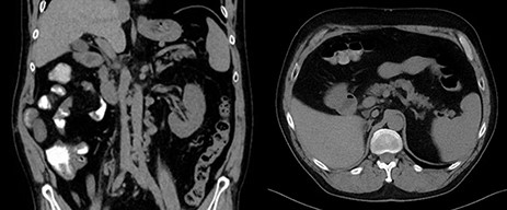Post-operative coronal and axial CT images showing free tumor bed and normal IVC.