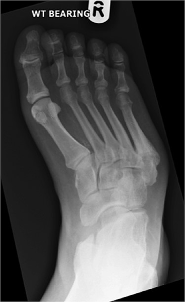 Anterior–posterior radiograph of right foot demonstrating fracture at base of fifth metatarsal and forefoot varus.
