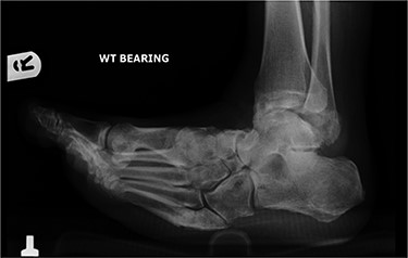 Lateral radiograph of foot demonstrating mid-foot collapse.